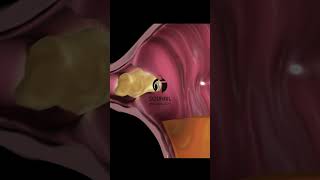 Gastroesophageal reflux disease GERD Short Overview shorts [upl. by Hennebery]