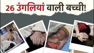 26 उंगलियां वाली बच्ची डॉक्टर्स ने बताया बीमारी का नाम Health News Rajasthan [upl. by Kirtap]