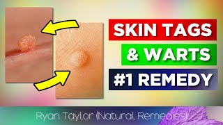 Use Iodine for Skin Tags amp Warts Removal [upl. by Assillem]