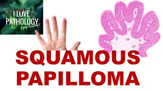 SQUAMOUS PAPILLOMA Etiopathogenesis Clinical Features and Pathology [upl. by Stanislaw]