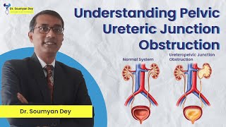 PUJ Obstruction  Pelvic Ureteric Junction Obstruction Understanding amp Treatment Options  Dr Dey [upl. by Dnomar]