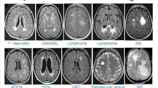 MRI Uses in MS [upl. by Dikmen995]