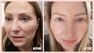 Under Eye Filler  Before amp After  My Experience [upl. by Arne]