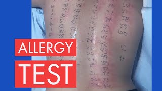 PRICK TEST ALLERGY TEST [upl. by Oiluj]