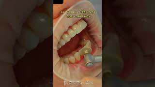 Carillas de resina como quedan dientes esteticadental dientesblancos [upl. by Brear37]