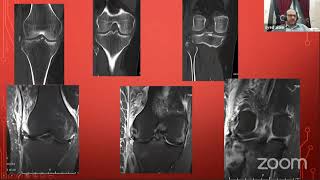 MRI of the Knee [upl. by Leagiba]