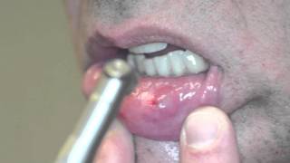 Fotona Laser Mucocele removal Boynton Laser Dental [upl. by Karp]