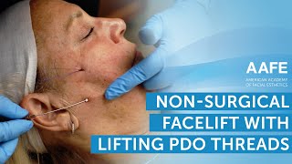 NonSurgical Facelift with Lifting PDO Threads  AAFE [upl. by Wilona]