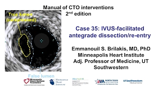 Case 35 Manual of CTO Interventions  IVUS facilitated ADR [upl. by Horwath]