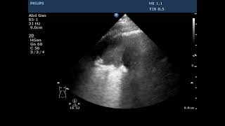 Lung POCUS  Consolidation and Hydropneumothorax [upl. by Zemaj]