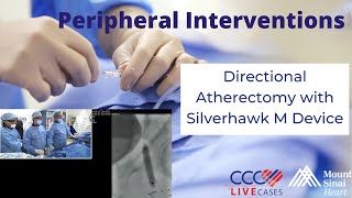 Directional Atherectomy with Silverhawk M Device  January 24 2018 [upl. by Eireva420]