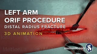 Left Arm ORIF Procedure of Distal Radius Fracture  3D Medical Animation [upl. by Kalila]