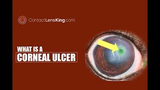 Corneal Ulcer Causes Symptoms Treatments [upl. by Esya]