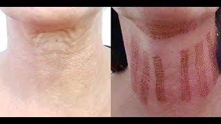 My neck lift non surgical [upl. by Chabot]