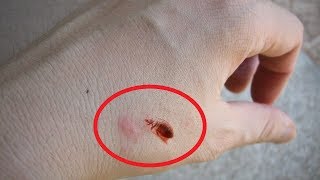 What Do Bed Bug Bites Look Like Rashes and Symptoms [upl. by Lessard]