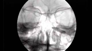 Balloon Sinuplasty Maxillary sinus [upl. by Seale531]