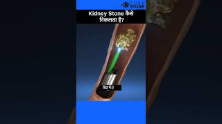 Kidney Stone treatment  laser treatment of ureteric stone  Shorts  RIRS [upl. by Tillinger]