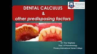 CALCULUS amp OTHER PREDISPOSING FACTORS [upl. by Alleras754]