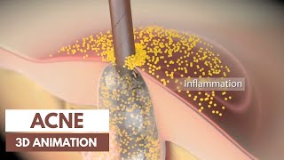 Acne basics  Pathophysiology amp Treatment  3D Animation [upl. by Engle730]