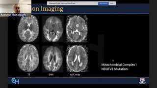 Radiological Diagnosis and Approach to Leukodystrophies [upl. by Eenram]