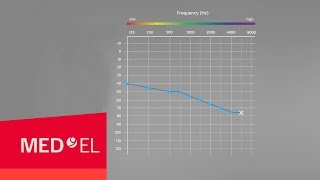 Audiograms Explained  MEDEL [upl. by Eillil]