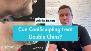 CoolSculpting A NonSurgical Solution for Your Double Chin [upl. by Turino]