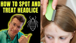 How to spot and treat Head lice nits  Doctor ODonovan explains [upl. by O'Doneven]