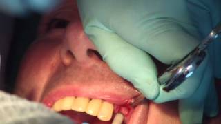 Préparation et pose dun implant dentaire partie 2 de 3 JMM DENTAL IMPLANT [upl. by Heck]