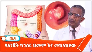 የአንጀት ካንሰር ህመም እና መከላከያው [upl. by Anuahsed]