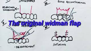 Periodontal flap Part3 [upl. by Peppie272]