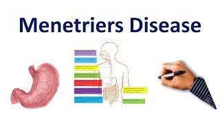 Menetriers Disease Made Easy USMLE Step 1 NCLEX COMLEX [upl. by Eillehs507]