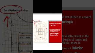 HESS CHART INTERPRETATION EXAMPLE [upl. by Oisangi101]