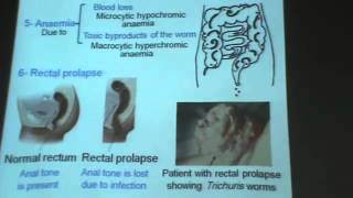 Dr Azza Helminths Nematodes 2 trichuris trichiura enterobius vermicularis YouTube [upl. by Etiragram573]