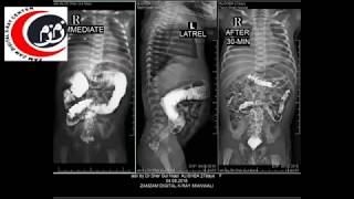 Barium Enema Procedure [upl. by Duke543]