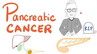 Pancreatic Cancer  Risk Factors Symptoms Signs Diagnosis Management [upl. by Marquet258]