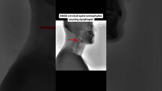 HUGE cervical spine osteophytes causing dysphagia [upl. by Wrand]