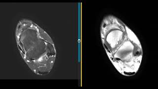 Lateral ankle pain and swelling [upl. by Crist570]