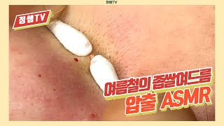 압출SMR 128 여름철 좁쌀여드름 고민 20대 女 [upl. by Leinto]