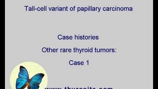 Tall cell variant of papillary carcinoma Other rare tumors  case 1 [upl. by Acimaj398]