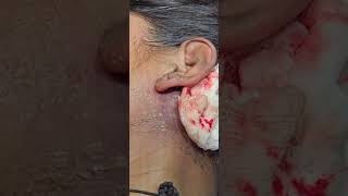 Drainage of abscess post aural region  incision and drainage  Dr Hitesh Patel [upl. by Va68]