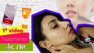 1ª Video Tratamento da acne com Tetraciclina e Creme Adapaleno [upl. by Chadbourne]