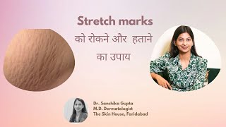 Stretchmarks  Prevention amp Treatment  Dr Sanchika Gupta 👩‍⚕️ bestskinspecialistinfaridabad [upl. by Ydna]