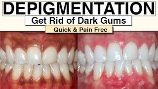 Black Gums How To Get Rid Of Them With Gum Depigmentation [upl. by Marquita]