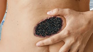 ASMR What Happened With Stomach  ASMR Maggots Navel Treatment  ASMR 2d Animation [upl. by Tomlinson326]