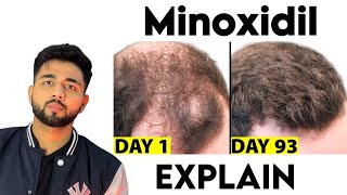 How To Use Minoxidil  Hair Regrowth  Oral Minoxidil  A Better Hair LossTreatment [upl. by Okeim]