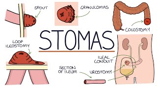 Understanding Stomas Colostomy Ileostomy Urostomy and Gastrostomy [upl. by Tuppeny336]