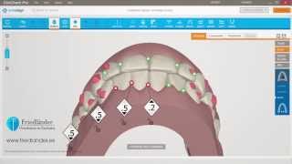 Invisalign ClinCheck Pro Tutorial contatos oclusales  Ortodoncia Friedländer Barcelona [upl. by Nnyledam]