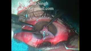 Conjunctival Graft Harvesting For Pterygium Excision With Autograft By Dr Sudhir Singh 32 [upl. by Larisa15]