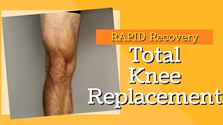 2 Key Exercises to Rapid Recovery for Total Knee Replacement [upl. by Mowbray566]