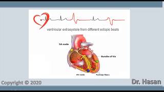 Extrasystole  Premature contraction  atrial nodal and ventricular extrasystole [upl. by Asin]